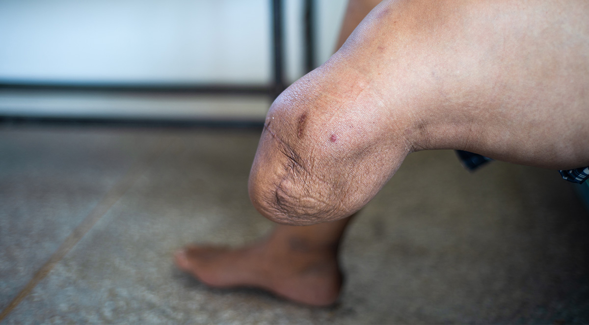 different_than_residual_limb_pain image different than residual limb pain