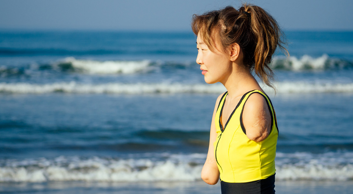 coping with limb loss